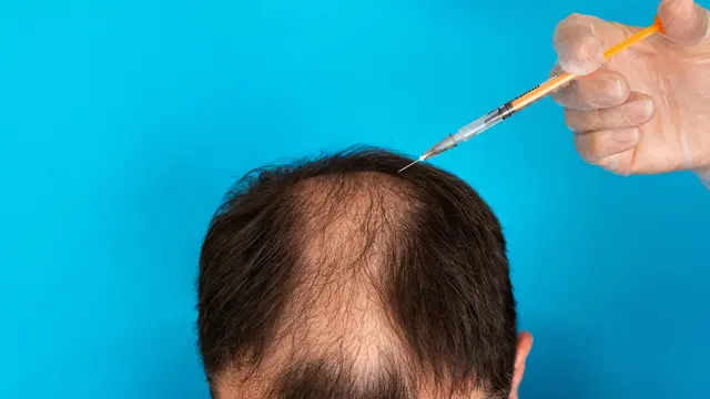 Transplantasi Rambut Gagal? Klinik Wajib Ganti Rugi Rp110 Juta